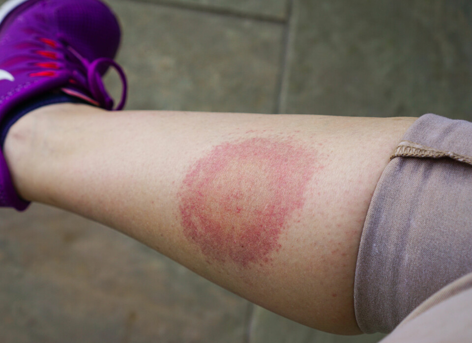A typical “bull’s eye” rash on a walker’s leg after having been bitten by a tick that could cause Lyme disease
