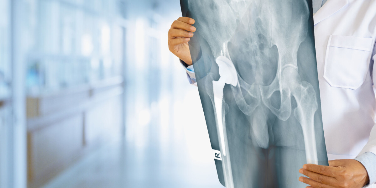My hip replacement success in france with new patient-centred protocol