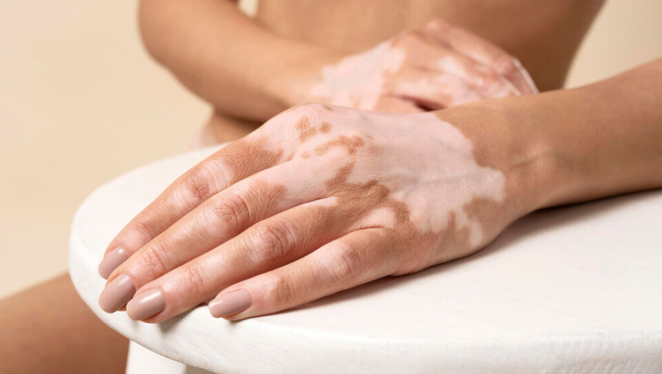 A woman with vitiligo patches on her hands