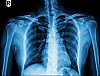 X-ray showing the right shoulder joint, upper chest and spine