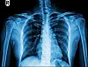 X-ray showing the right shoulder joint, upper chest and spine